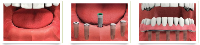 implant supported dentures graphic Pittsfield, MA