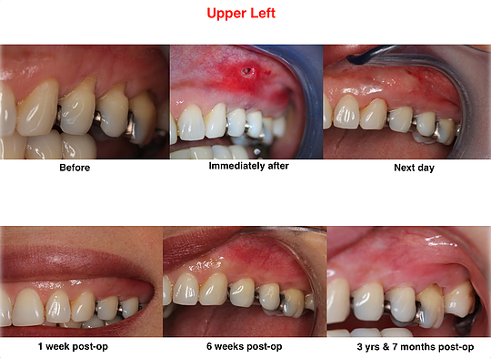 This is actually a write-up or even photo around the Pinhole Surgical Techn...