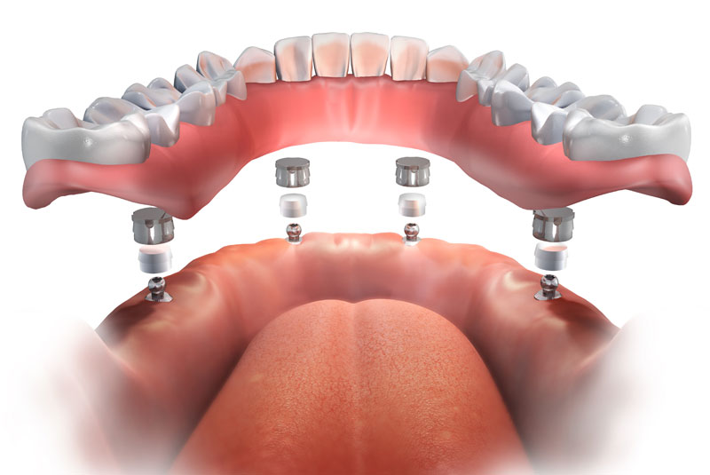 ball retained dentures graphic Pittsfield, MA