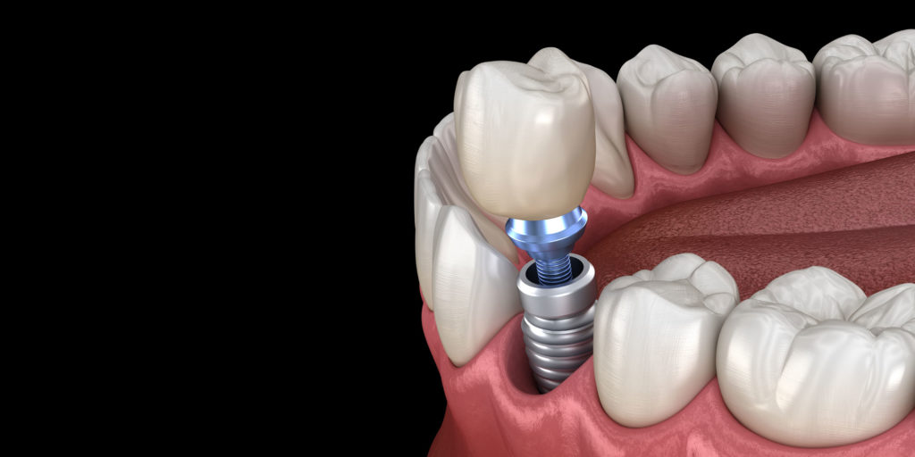 dental implant model Pittsfield, MA