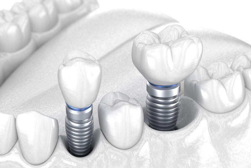 dental implant model Pittsfield, MA