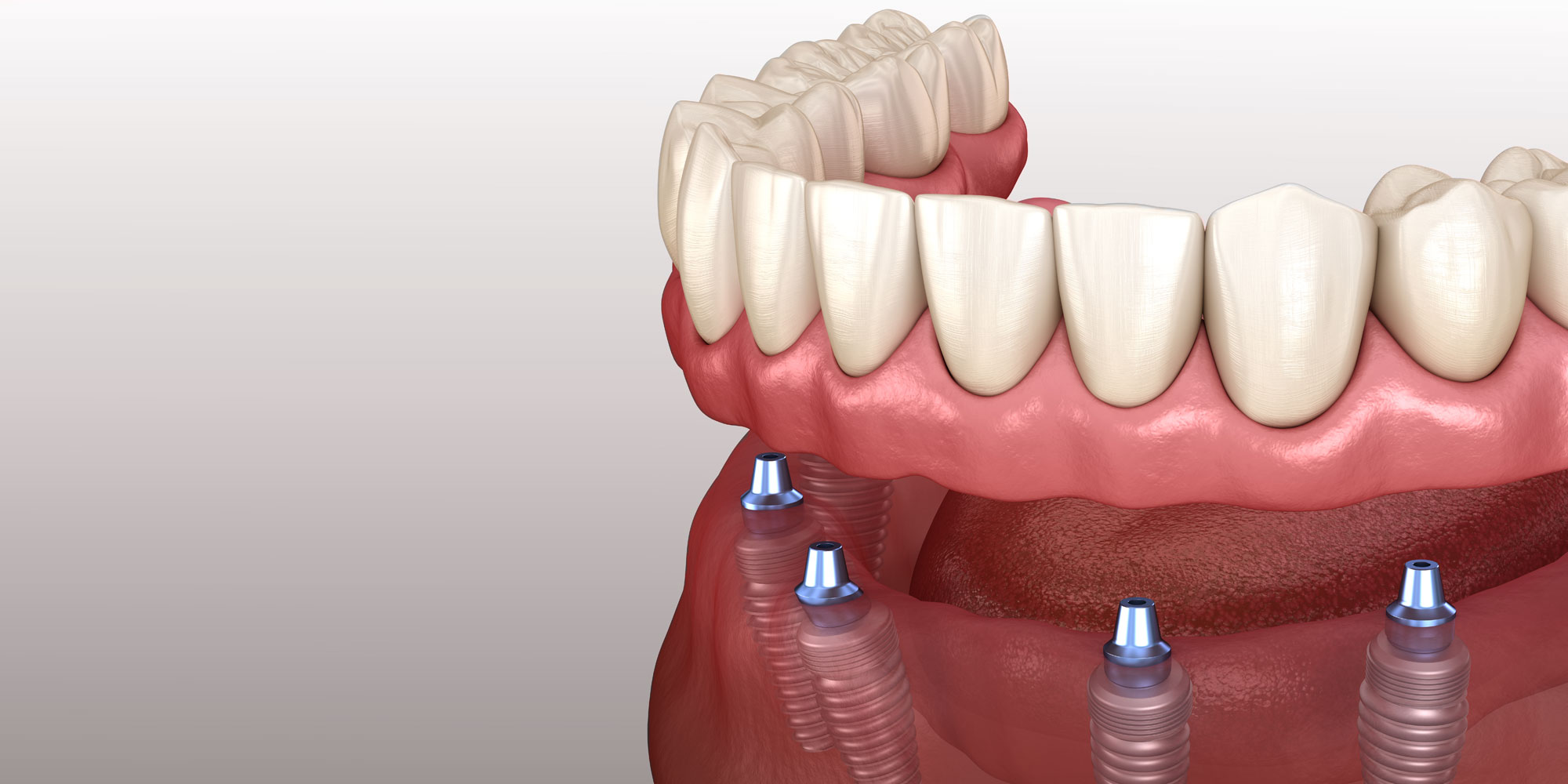 Achieving A Perfect Smile: Top Dental Implants Clinics in Massachusetts
