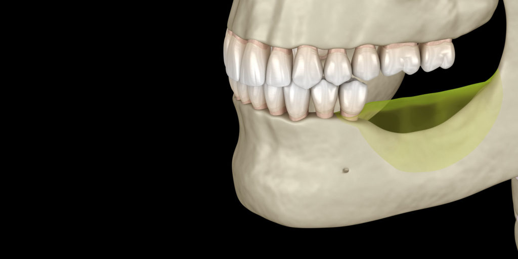 jaw bone loss graphic Pittsfield, MA