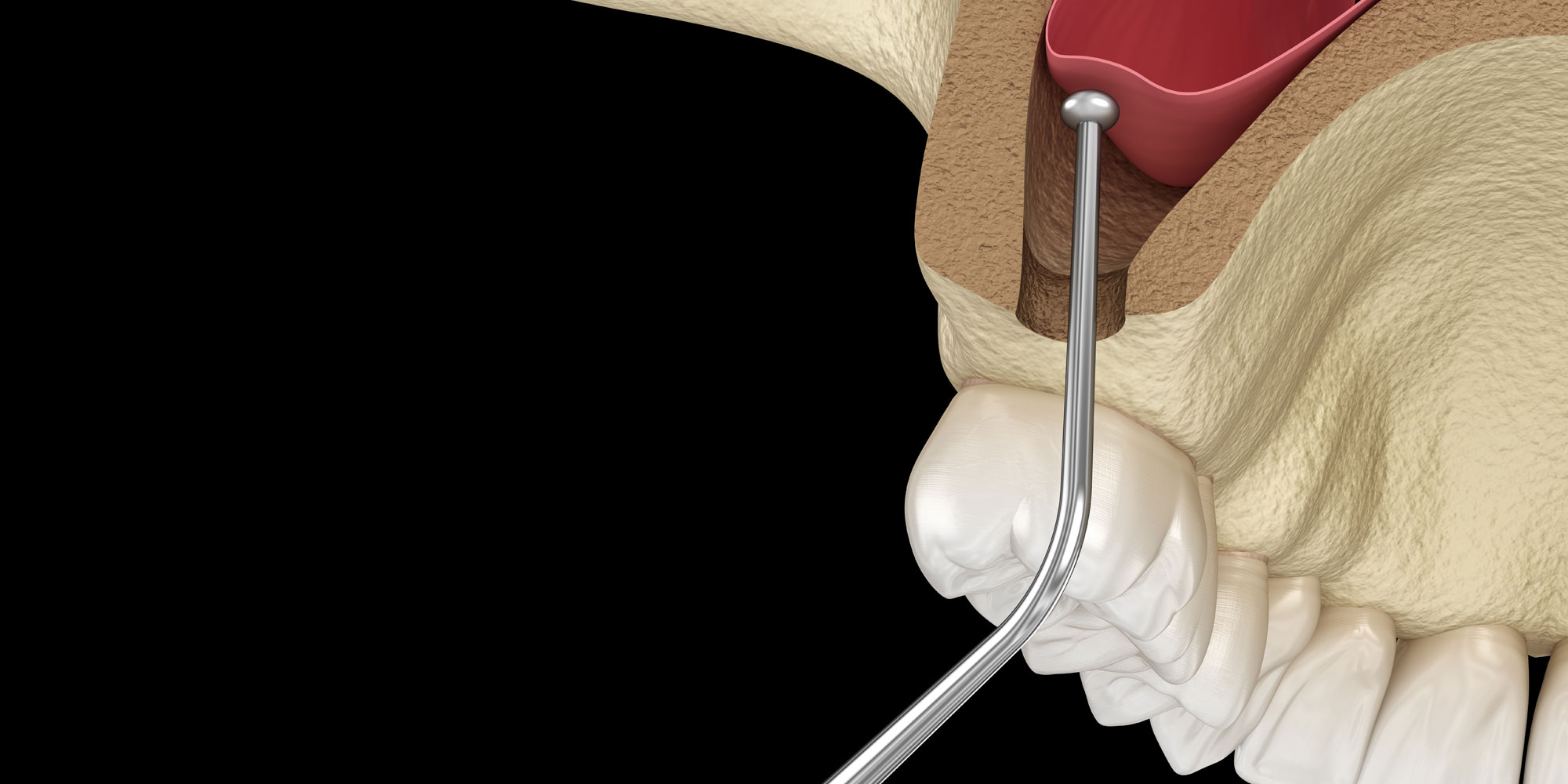 Sinus Lift | Pittsfield, MA | Michael J Williams, DMD, PC