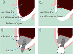 sinus lift graphic Pittsfield, MA