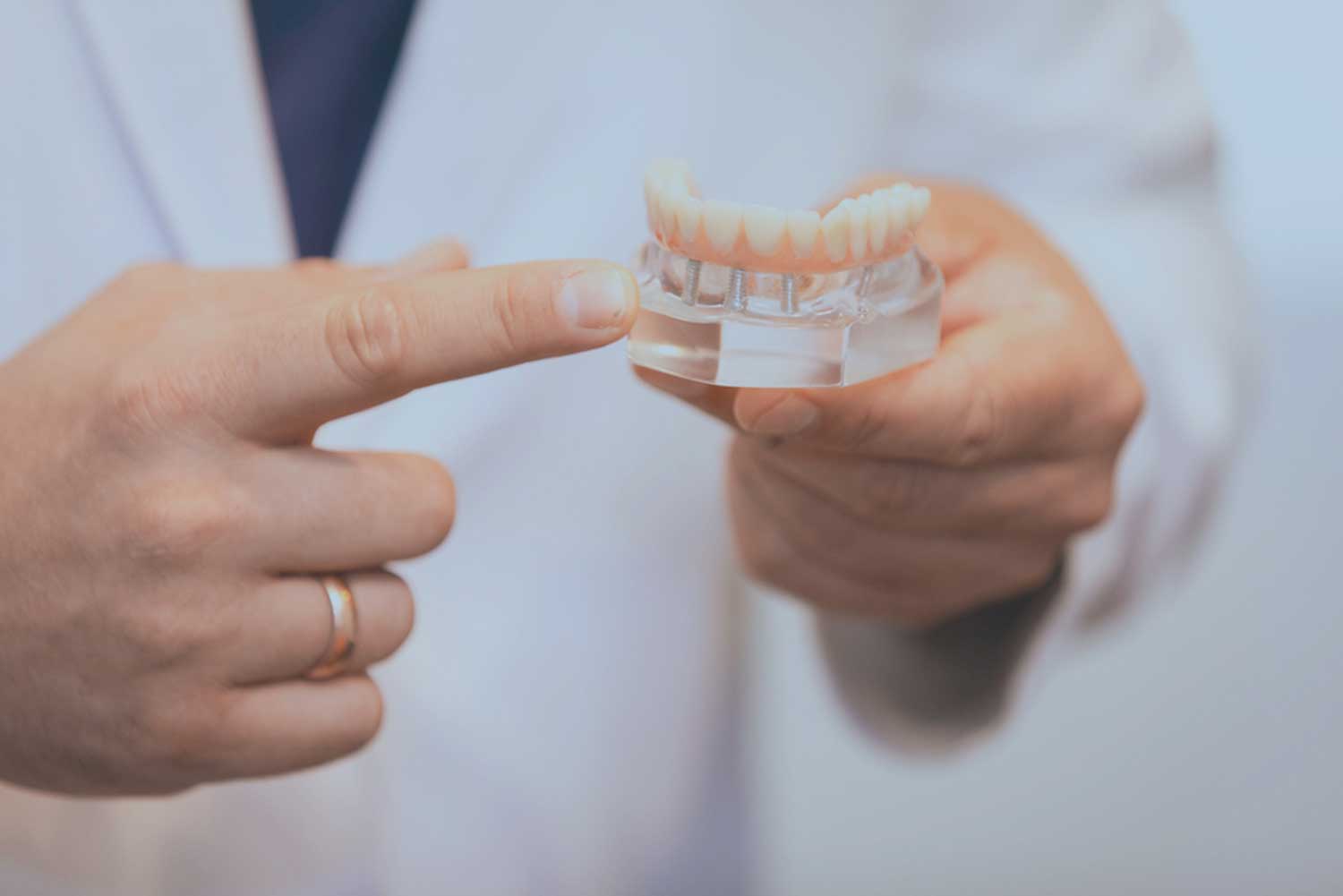 a model of a placed implant supported denture