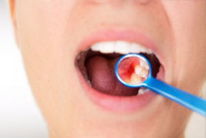 Dental Patient Requiring Periodontal Treatment