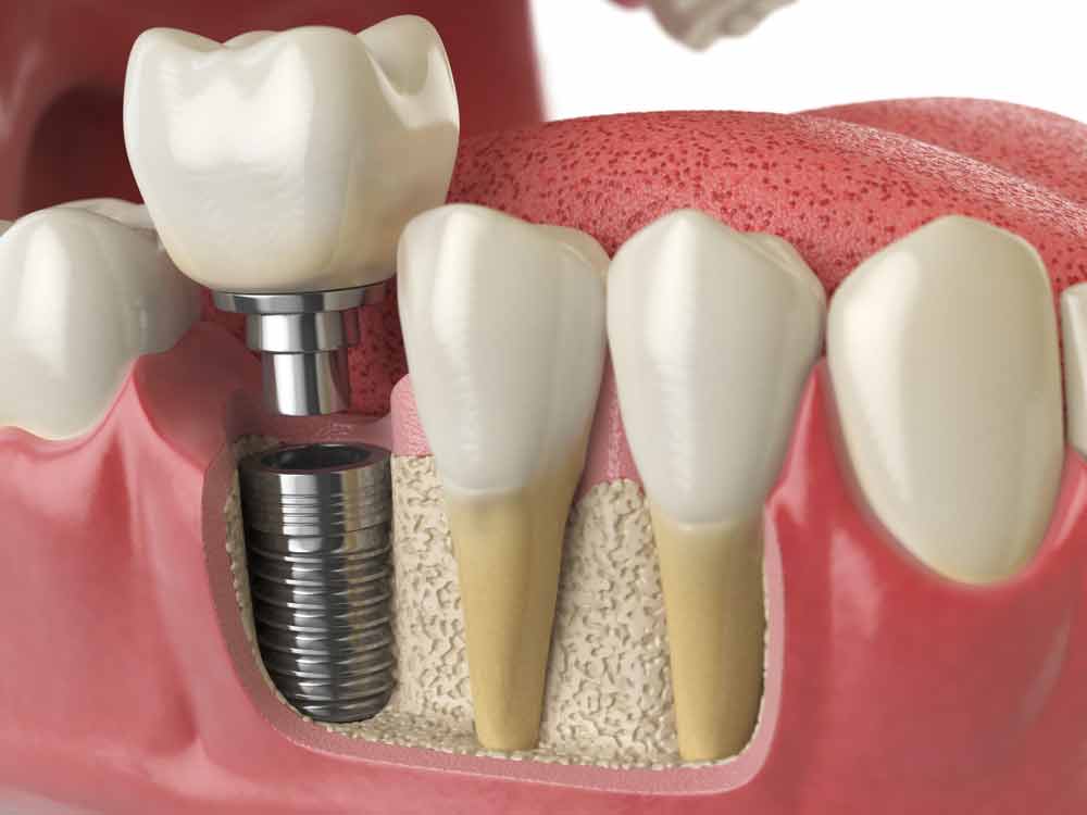 a model of a dental implant being placed