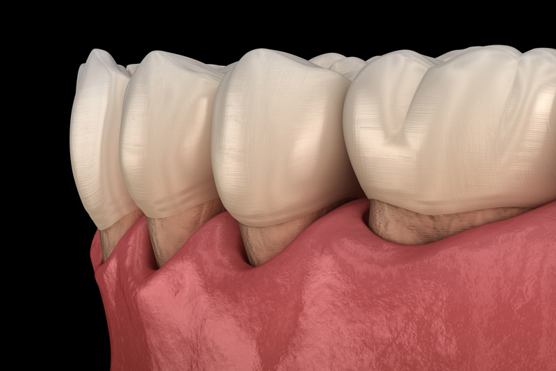 Gum Recession Close Up