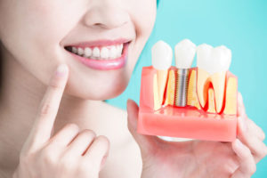 Dental Patient Holding Up A Dental Implant Model