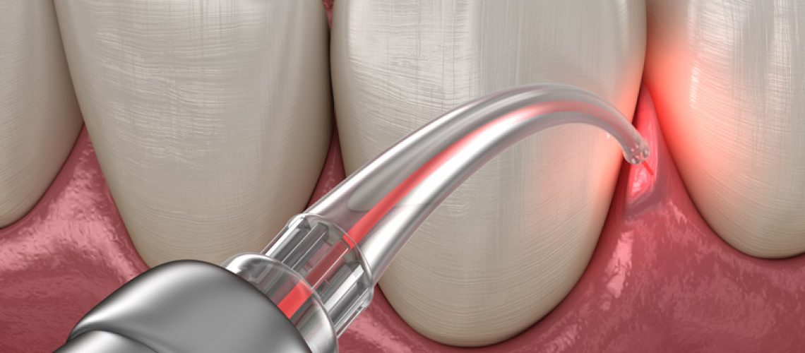 Gum Disease Laser Treatment Close Up