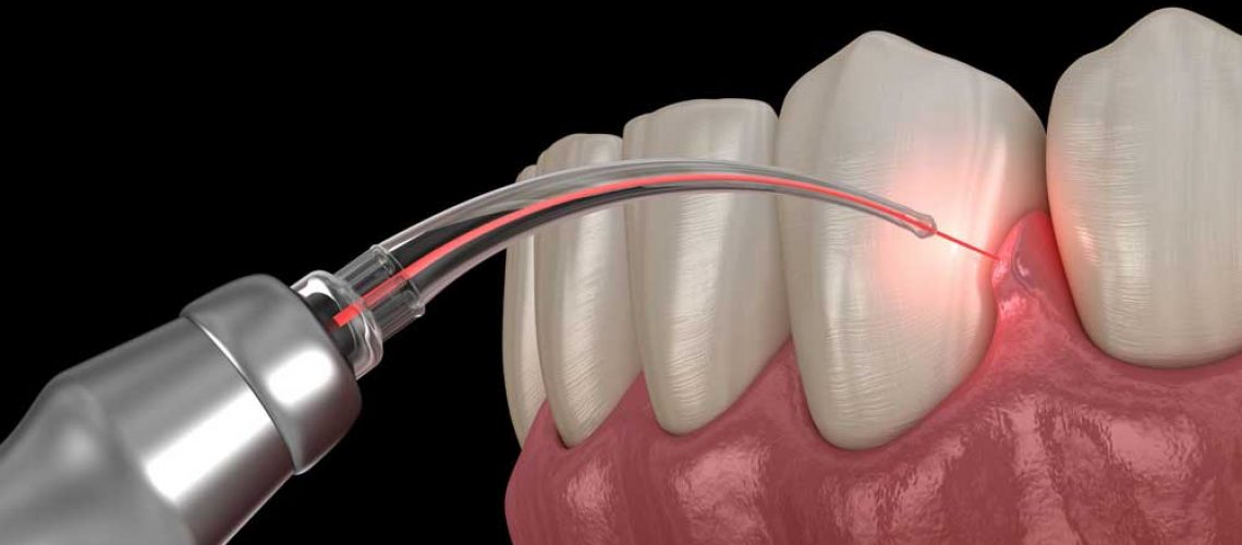 Gum Disease Treatment Graphic